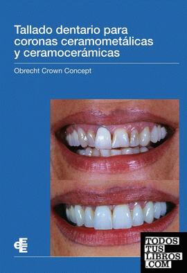 Tallado dentario para coronas ceramometálicas y ceramocerámicas