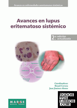 Avances en lupus eritematoso sistémico