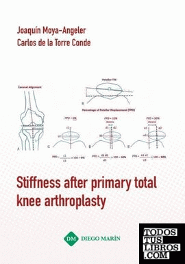 STIFFNESS AFTER PRIMARY TOTAL KNEE ARTHROPLASTY
