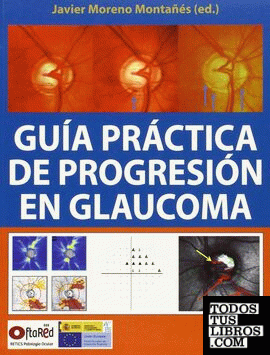 Guía práctica de progresión en glaucoma