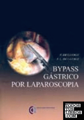 Bypass gástrico por laparoscopia