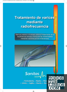 Tratamiento de varices mediante radiofrecuencia