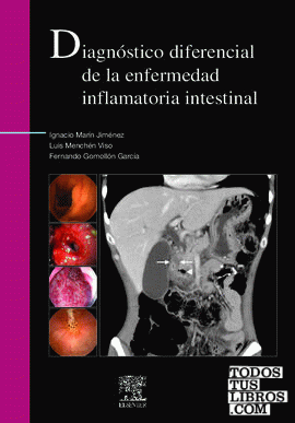 Diagnóstico diferencial de la enfermedad inflamatoria intestinal