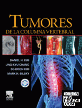 Tumores de la columna vertebral