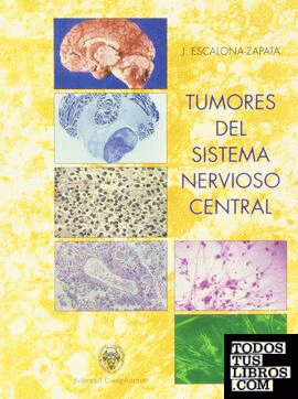 Tumores del sistema nervioso central