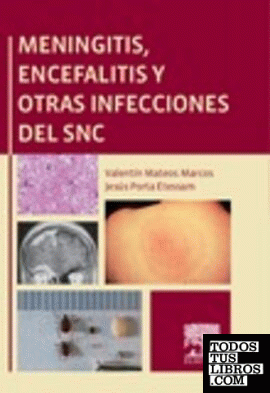 Meningitis, encefalitis y otras infecciones del SNC